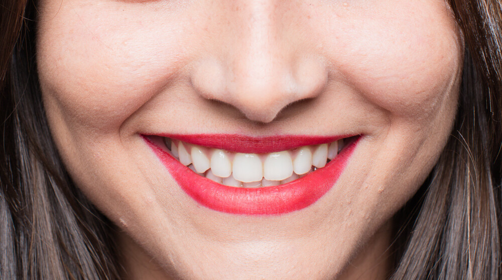 beneficios-sonrisa-gingival